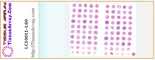 TissueArray.Com Tissue Array LC10011-L60