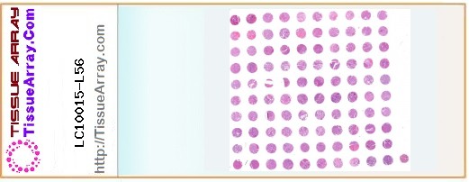 TissueArray.Com Tissue Array LC10015-L56