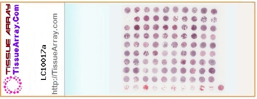 TissueArray.Com Tissue Array LC10017a
