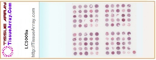 TissueArray.Com Tissue Array LC1009a