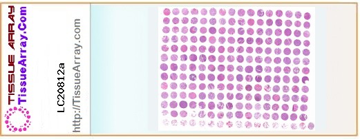 TissueArray.Com Tissue Array LC20812a