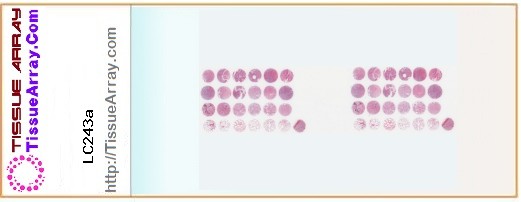 TissueArray.Com Tissue Array LC243a