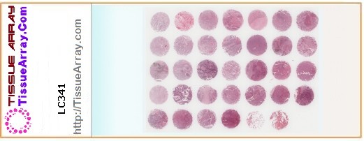 TissueArray.Com Tissue Array LC341