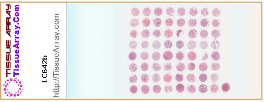 TissueArray.Com Tissue Array LC642b