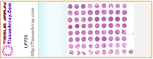 TissueArray.Com Tissue Array LP721