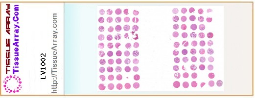 TissueArray.Com Tissue Array LV1002