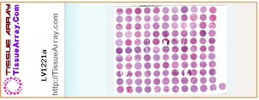 TissueArray.Com Tissue Array LV1221a