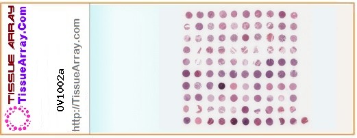 TissueArray.Com Tissue Array OV1002a