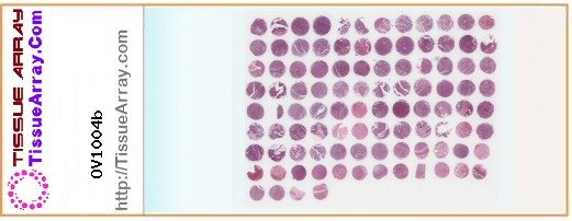TissueArray.Com Tissue Array OV1004b