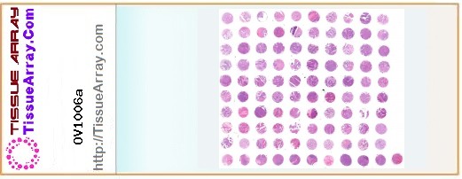 TissueArray.Com Tissue Array OV1006a