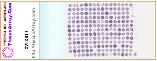 TissueArray.Com Tissue Array OV20811