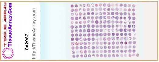 TissueArray.Com Tissue Array OV2082