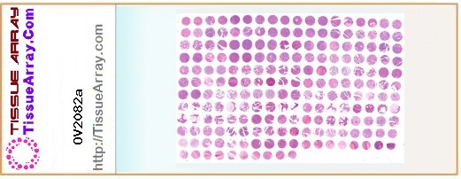 TissueArray.Com Tissue Array OV2082a