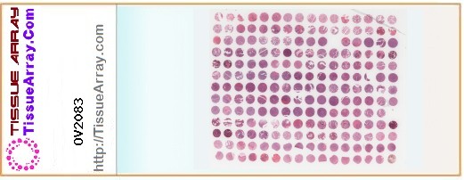 TissueArray.Com Tissue Array OV2083
