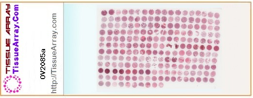 TissueArray.Com Tissue Array OV2085a