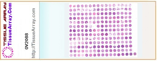 TissueArray.Com Tissue Array OV2088