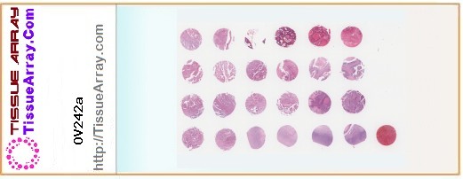 TissueArray.Com Tissue Array OV242a