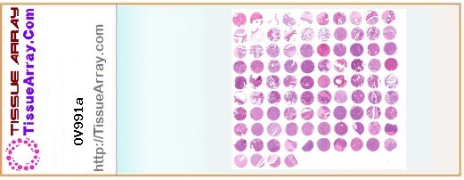 TissueArray.Com Tissue Array OV991a