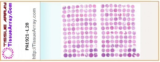 TissueArray.Com Tissue Array PA1921-L28