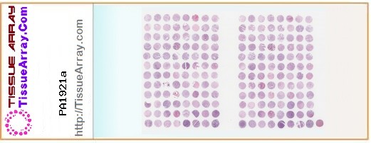 TissueArray.Com Tissue Array PA1921a