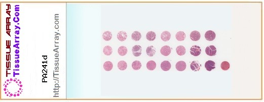 TissueArray.Com Tissue Array PA241d