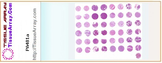 TissueArray.Com Tissue Array PA481a