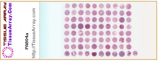 TissueArray.Com Tissue Array PA804a