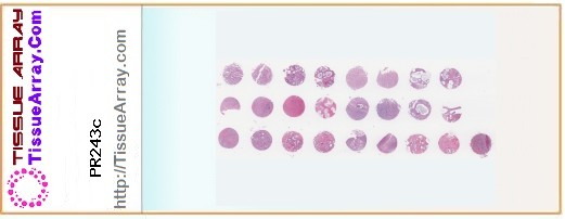 TissueArray.Com Tissue Array PR243c