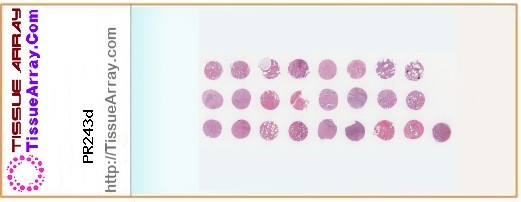 TissueArray.Com Tissue Array PR243d