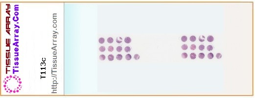 TissueArray.Com Tissue Array T113c