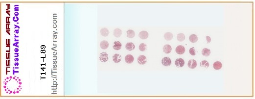 TissueArray.Com Tissue Array T141-L89