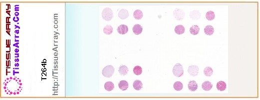 TissueArray.Com Tissue Array T264b