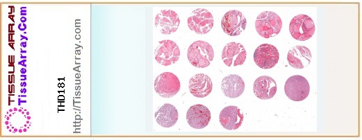 TissueArray.Com Tissue Array THD181
