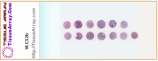 TissueArray.Com Tissue Array VLC12b